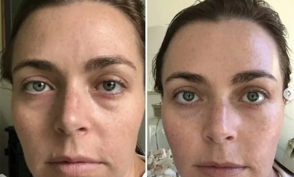 Side-by-side customer photo of the same woman, with under-eye puffiness on the left and a settled face on the right
