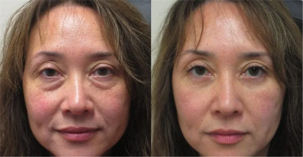 Side-by-side customer photo of the same face, puffy on the left and less swollen on the right