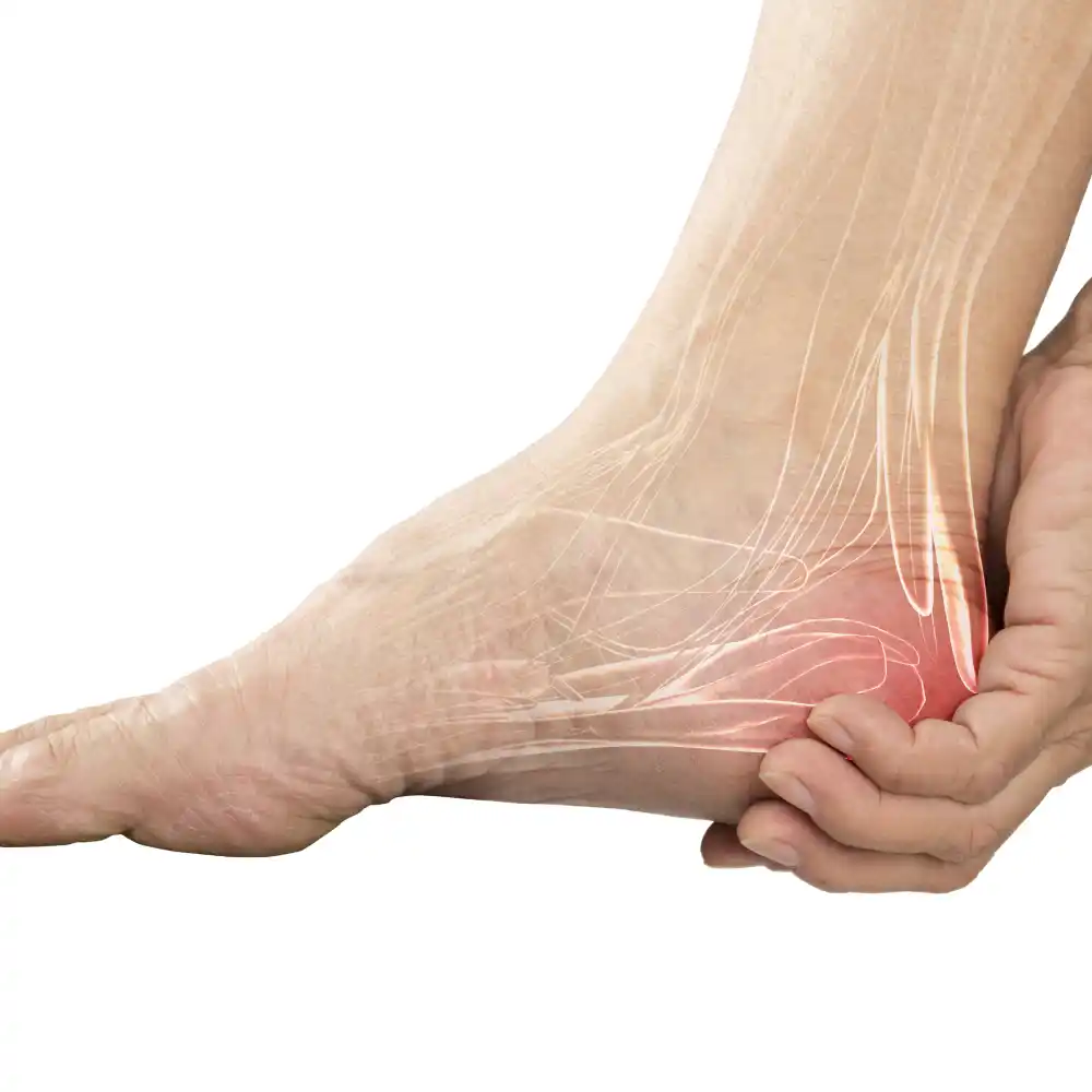 Illustration of the nerves in a human foot, highlighted at the heel — where diabetic and peripheral neuropathy discomfort is often felt first