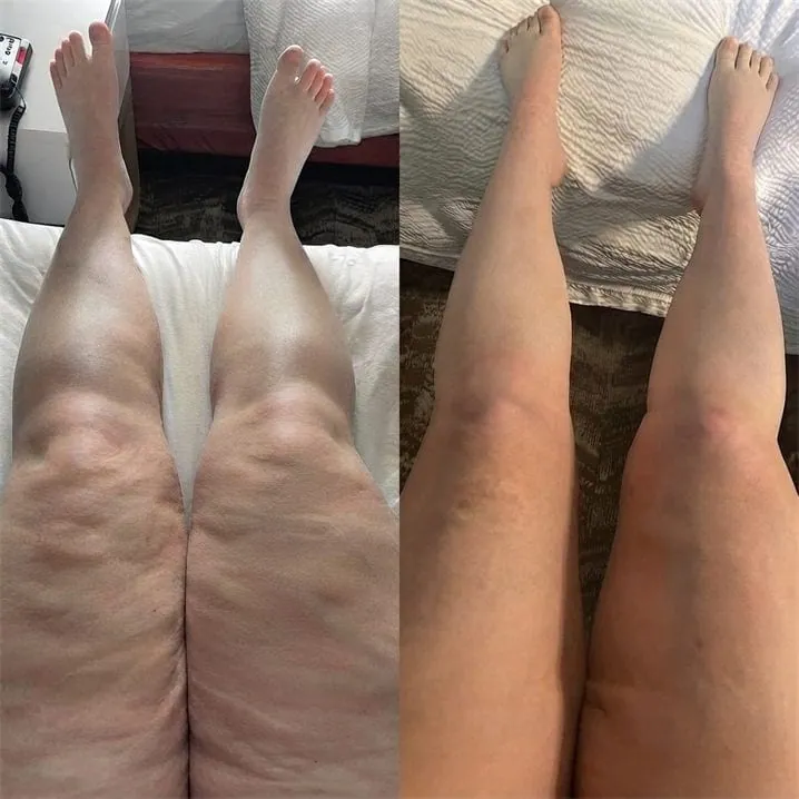 Before and after photo of a customer’s legs, published by the manufacturer