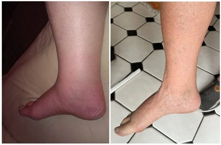 Before and after photo of a customer’s ankle, published by the manufacturer