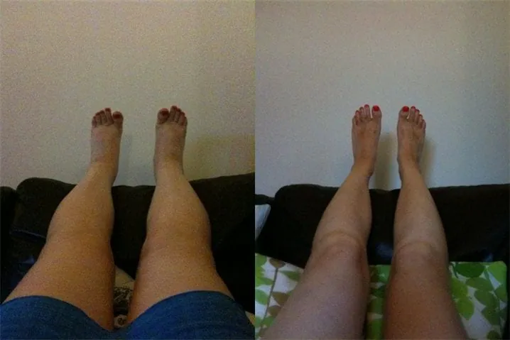 Before and after photo of a customer’s lower legs, published by the manufacturer