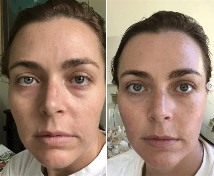 Before and after photo of a customer’s face, published by the manufacturer