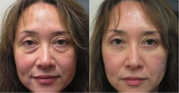Before and after photo of a customer’s eye area, published by the manufacturer